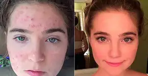 Gêmeas curam acne severa apenas com mudança na alimentação