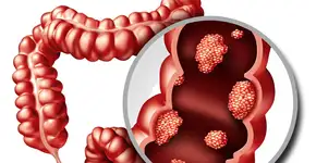 Novo tratamento recupera 100% dos pacientes com câncer colorretal