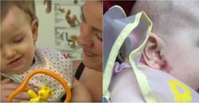 Bebê contrai herpes por meio de beijos da mãe