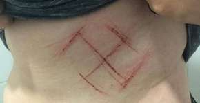 Suástica feita em jovem por fãs de Bolsonaro é fake news