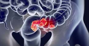 Foto: (iStock/ChrisChrisW)