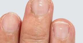 Mudanças nas unhas podem ser o primeiro sinal de câncer