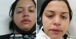 Mulher atacada pelo ex-patrão com ácido teme perder visão