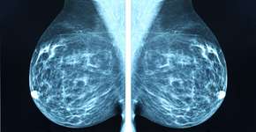 Medicamento reduz risco de retorno de câncer de mama