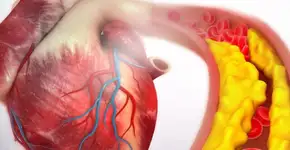 Saiba como controlar o colesterol ruim