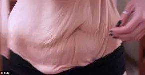 Após perder 90 kg, mulher faz apelo para remover excesso de pele
