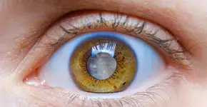 Glaucoma: entenda os sintomas, os riscos e como proteger sua visão