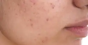 Jornalista faz relato sobre como a acne a fez evoluir como mulher