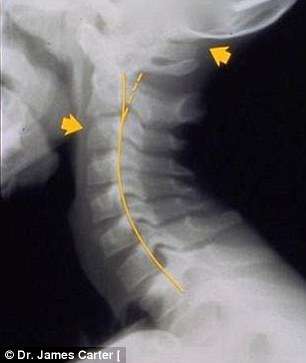 Espinhas dorsais completamente curvadas que resultam em problemas graves de coluna e para o pescoço é a principal consequência da tecnologia para a saúde da nova geração (Reprodução/The Daily Mail) 