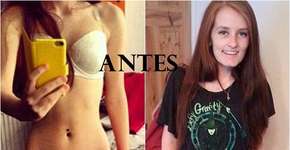 Com pouco mais de 30 quilos, anoréxica se pesava todo dia e resolveu mudar