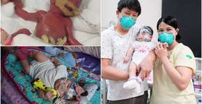 Menor bebê do mundo ganha alta após um ano no hospital