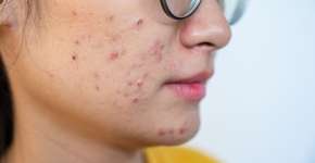 Novo estudo revela o que pode melhorar a acne de forma natural