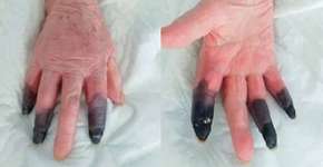 Foto: (reprodução/European Journal of Vascular and Endovascular Surgery)