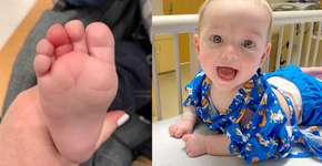 Mãe faz alerta após fio de cabelo cortar circulação do dedo de bebê