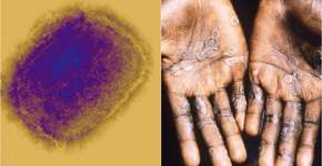 Foto: (Science Photo Library/CDC)