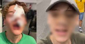 Influenciador digital leva 30 pontos no rosto após garrafada em SP