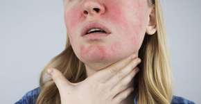 O que provoca a rosácea? Veja os sintomas e saiba como evitar