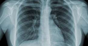 Dezembro Vermelho: pessoas com HIV tem mais risco de contrair a tuberculose; SUS disponibiliza exame gratuito