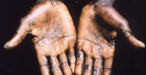 Foto: (BRIAN W.J. MAHY/CDC)