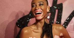 Modelo com vitiligo de 22 anos brilha em evento na Inglaterra