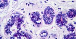 Estes são os tipos de câncer mais comuns em idosos