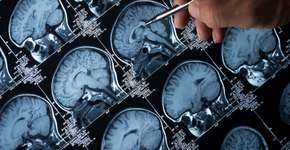 Este remédio é capaz de retardar progressão do Alzheimer em 60%