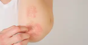 Hepcidina pode ser a chave para tratar a psoríase