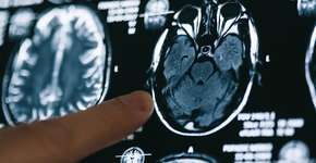 Descoberto o medicamento que retarda a progressão do Alzheimer