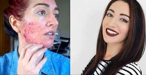 Blogueira de beleza acaba com a acne após 15 anos de tentativa