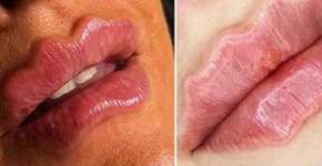 ‘Devil lips’: nova tendência de preenchimento pode trazer riscos