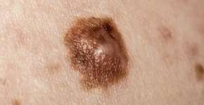 Quais são os sinais de alerta do câncer de pele?