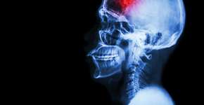 15 fatores que podem te levar a sofrer um AVC antes dos 45 anos