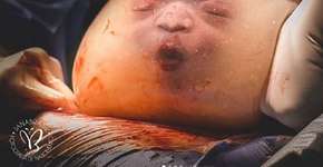 Parto de bebê empelicado impressiona e viraliza na web