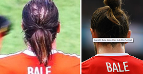 Esconder a calvície com coques da moda pode piorar o problema