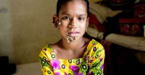 Garota de Bangladesh tem suspeita de “síndrome do homem árvore”