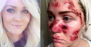 Mulher com câncer de pele mostra riscos de bronzeamento artificial