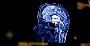 Estes são os sintomas que indicam o risco de aneurisma cerebral