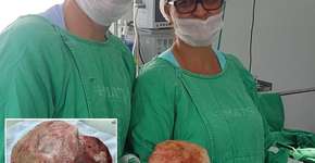 Na Bahia, homem de 51 anos retira pedra de 1,3kg e 18cm da bexiga