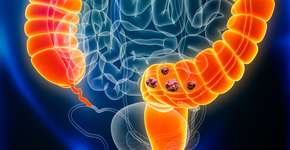 5 hábitos que evitam 30% dos casos de câncer colorretal para adotar hoje