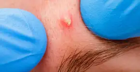 Por que vídeos de espinhas sendo estouradas causam fascínio?