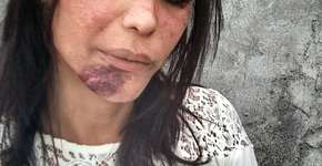 Mulher trans publica foto ‘machucada’ como protesto contra a transfobia