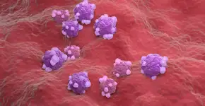 Sinais comuns do câncer de ovário que não devem ser subestimados