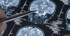 Exame detecta Alzheimer em 10 minutos