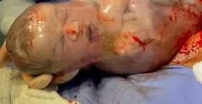 Vídeo de médico rompendo bolsa de bebê empelicado viraliza