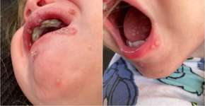 Como um beijo de um adulto quase matou um bebê?