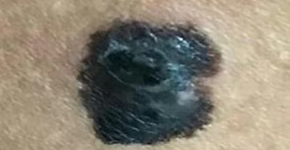 Enfermeira descobre que mancha de nascença era câncer após 2 sintomas