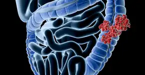 Estudo mostra que dieta rica em folato reduz câncer de intestino