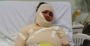 Mulher tem 70% do corpo queimado após marido jogar óleo fervente