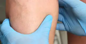 Risco de trombose aumenta após cirurgia?